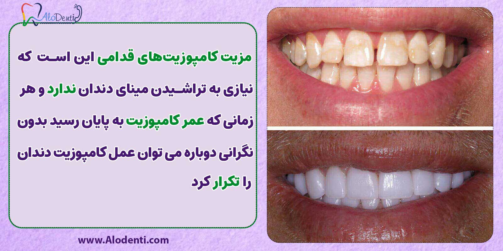 انواع کامپوزیت دندان: مزیت کامپوزیت های قدامی